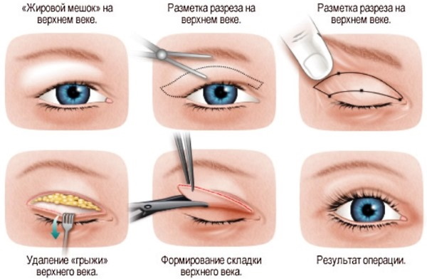 Plastic surgery on the eyelids. Before and after photos, price, reviews