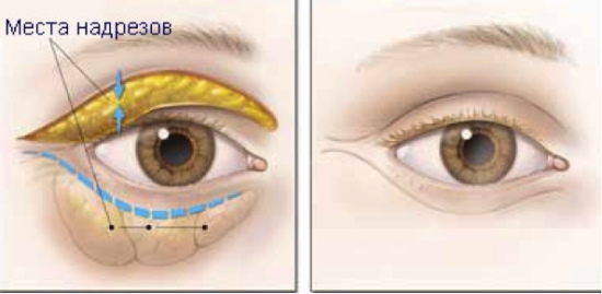 Plastic surgery on the eyelids. Before and after photos, price, reviews