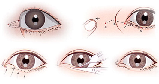 Plastic surgery on the eyelids. Before and after photos, price, reviews