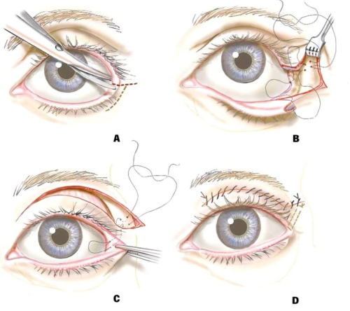 Plastic surgery on the eyelids. Before and after photos, price, reviews