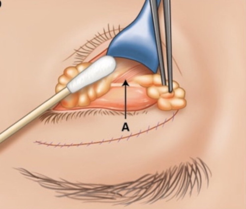 Plastic surgery on the eyelids. Before and after photos, price, reviews