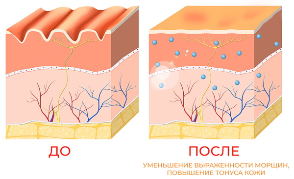 Revi (Revi und Revi Brilliants) ist ein Medikament zur Biorevitalisierung