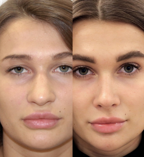 The girl has a big nose. Photos before and after rhinoplasty