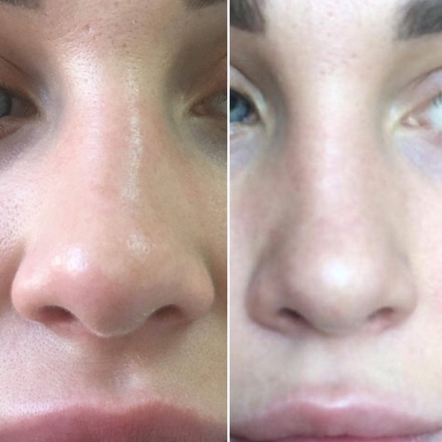 The girl has a big nose. Photos before and after rhinoplasty