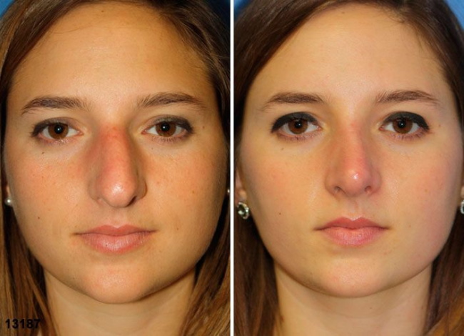 The girl has a big nose. Photos before and after rhinoplasty