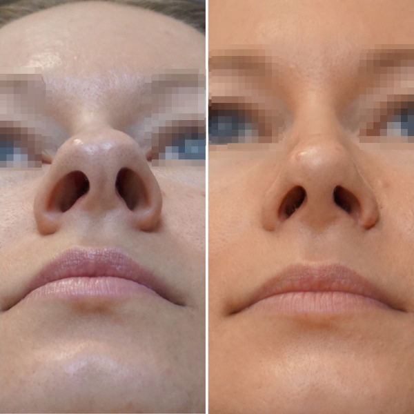 The girl has a big nose. Photos before and after rhinoplasty