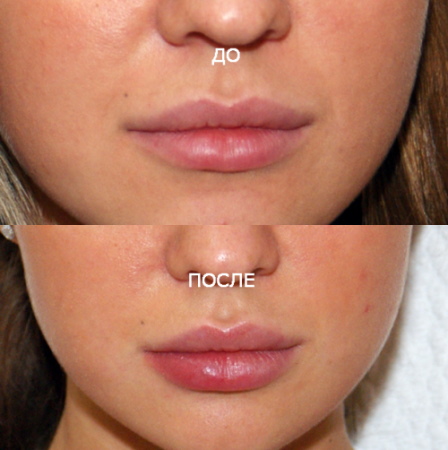 Girls have thin lips. How to increase with hyaluronic acid, filler, botox