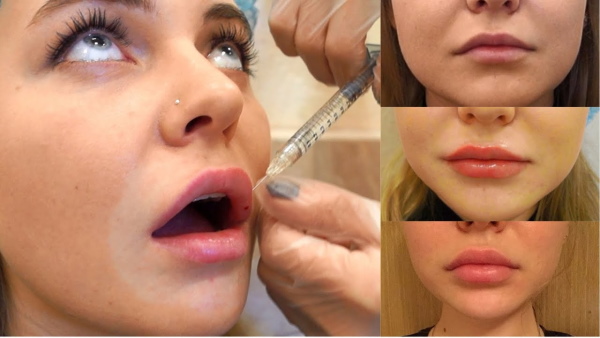 Le ragazze hanno labbra sottili. Come aumentare con acido ialuronico, filler, botox